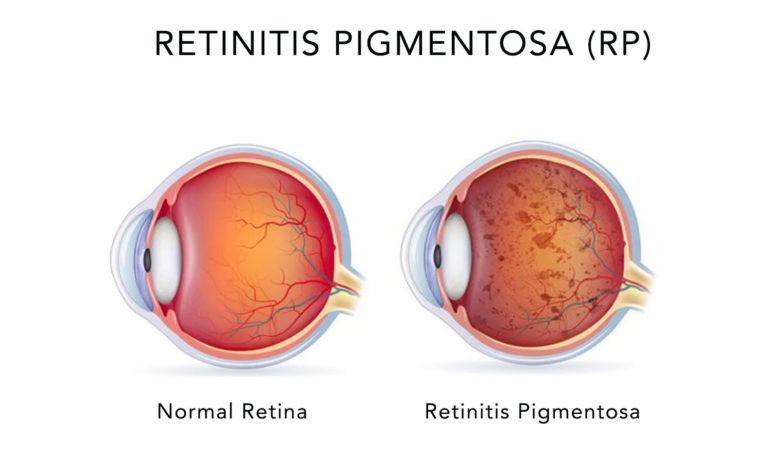 Retinitis Pigmentosa Eye Health Institute