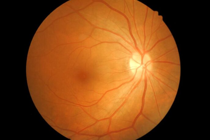 Fundus photo showing orange retina, pale optic disc at right, darker macula at left, with branching blood vessels.