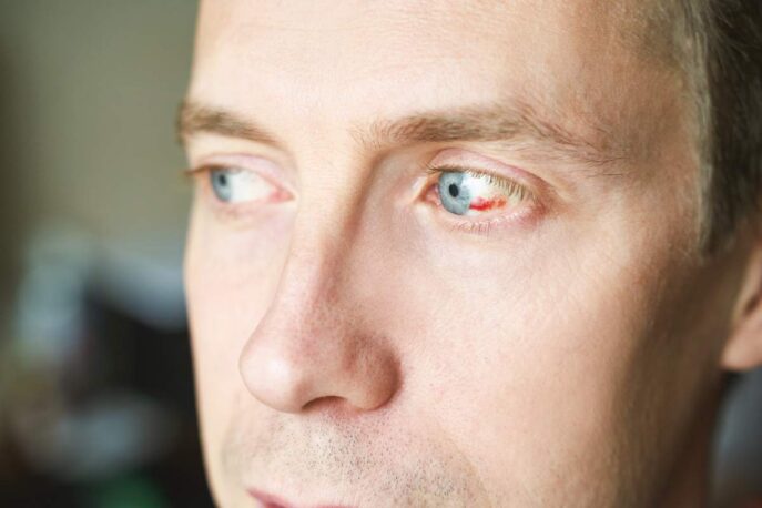 Close-up of a man’s face with a bright red patch on the white of his eye, looking off to the side.