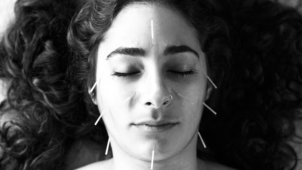 Patient receiving micro acupuncture treatment for vitreous health