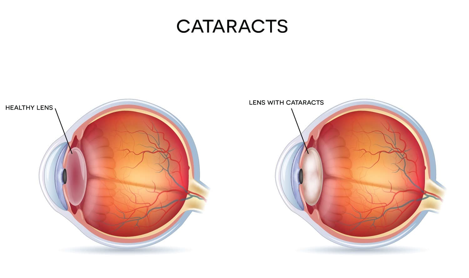 Side-by-side illustration comparing a healthy eye lens with a lens affected by cataracts