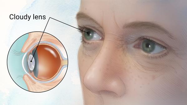 Illustration showing a cloudy lens in the eye of an older adult, indicating cataract.