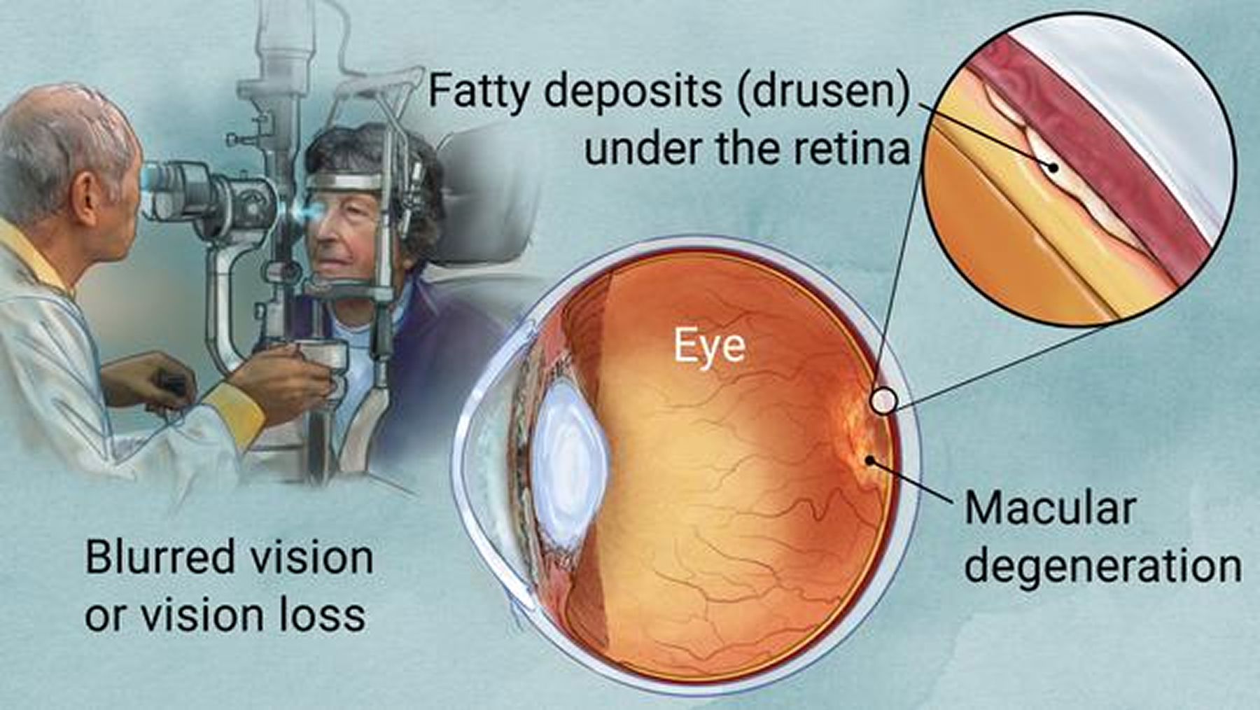 Macular degeneration
