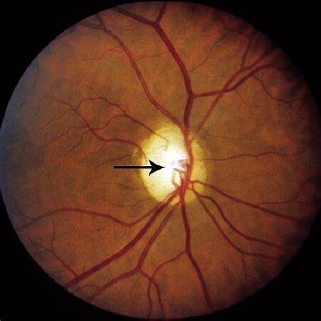 Fundus photo showing a pale optic disc typical of optic nerve atrophy