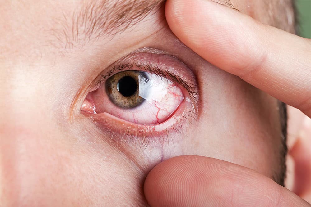 Close-up of an eye with visible redness and irritation.