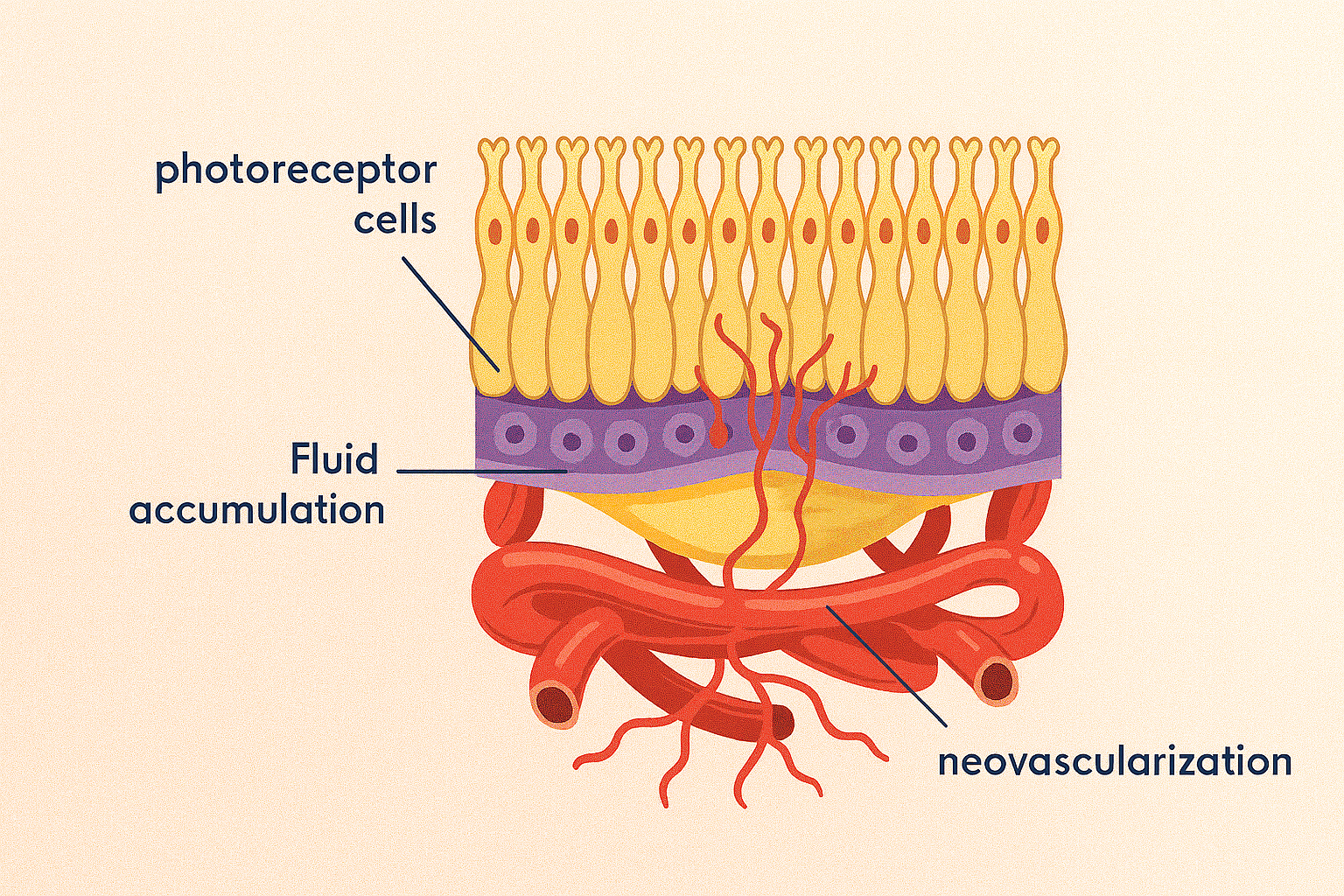 medical illustration of the retina showing key pathological features associated with Wet Age-Related Macular Degeneration.